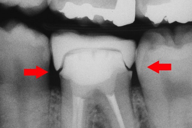 レントゲンで見ると、詰め物と歯に隙間がある。こんな治療の歯医者で、定期検診して、意味ないのでは？