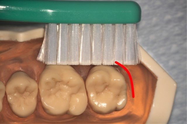 一番奥の歯を抜いたら_上の一番奥の歯の磨き方_ハブラシの当て方 (1)