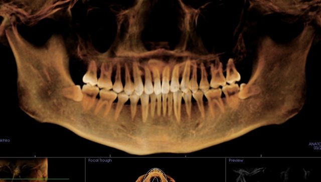歯医者の定期健診は意味ない_銀歯の少ない方_CTから再構成したパノラマレントゲン