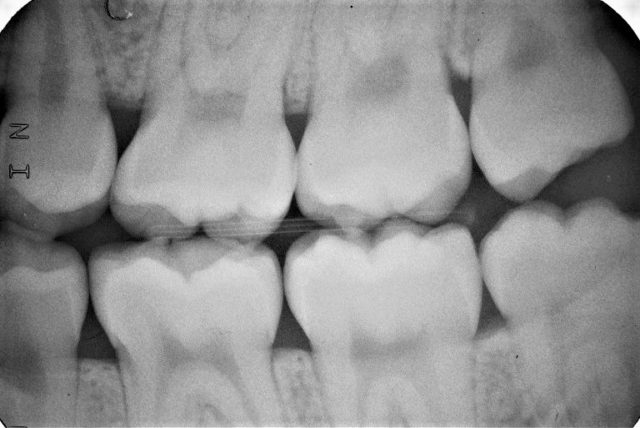 歯医者の定期健診は意味ない_虫歯がはっきり写るバイトウイング