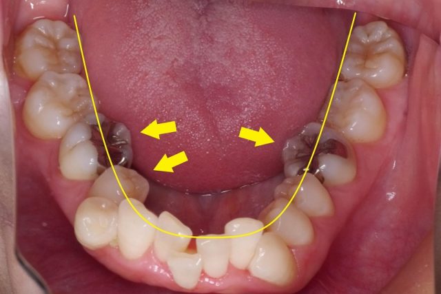 舌が痛い_歯が当たる_下の奥歯 (2)