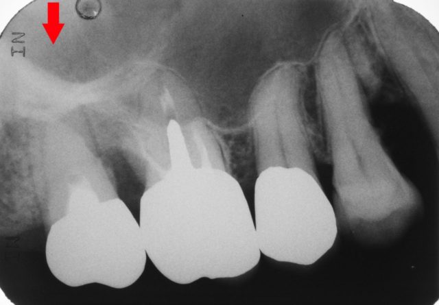 アルパーク歯科_広島市_設備_デンタル歯科用X線撮影装置_上顎洞炎は分からない