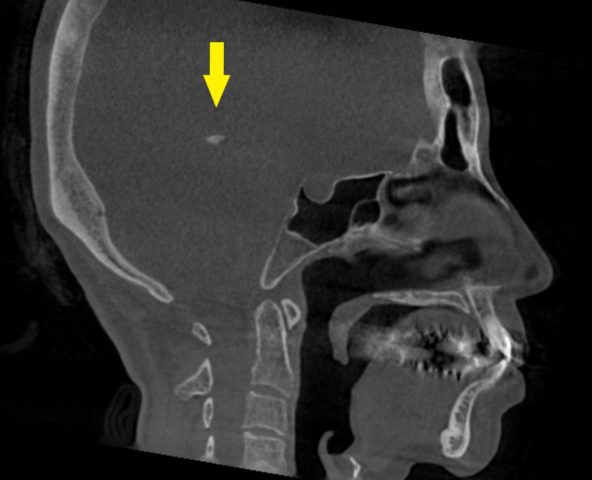 アルパーク歯科_広島市_設備_アーム型X線CT診断装置_脳内の石灰化物