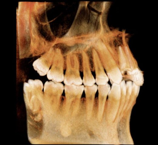 アルパーク歯科_広島市_設備_アーム型X線CT診断装置_歯牙モード
