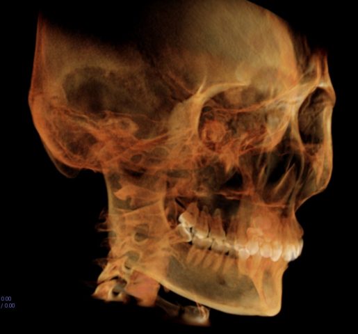 アルパーク歯科_広島市_設備_アーム型X線CT診断装置_3D Volume Render
