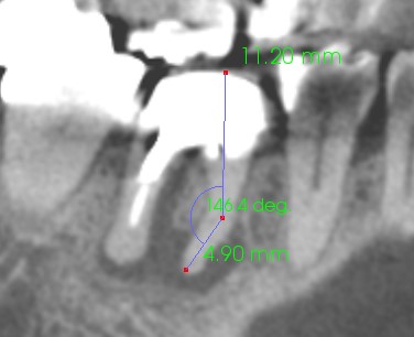 歯医者のCTでわかること_根尖性歯周炎の根管長測定_アルパーク歯科_広島市西区