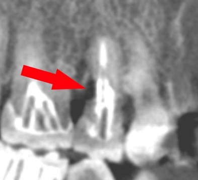 歯医者のCTでわかること_歯の外部吸収_矢状面_アルパーク歯科_広島市西区