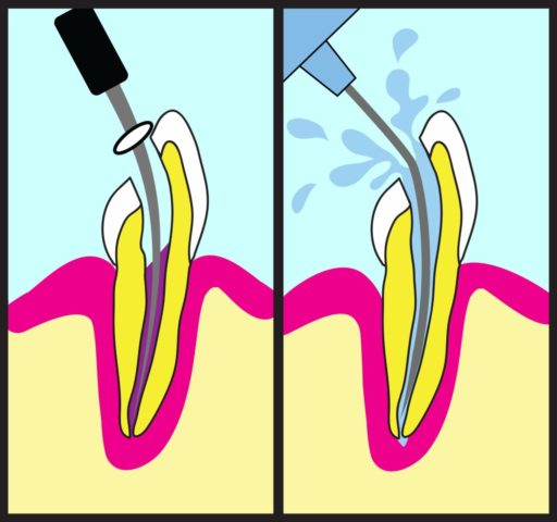 歯根治療のイラスト（根管拡大、洗浄）