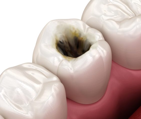 歯髄腔へのアクセスの穴