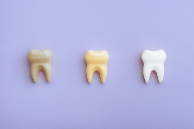 神経を抜くと、歯の色が変色することがある