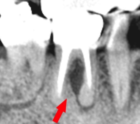 根管の穿孔による、歯周組織の骨吸収