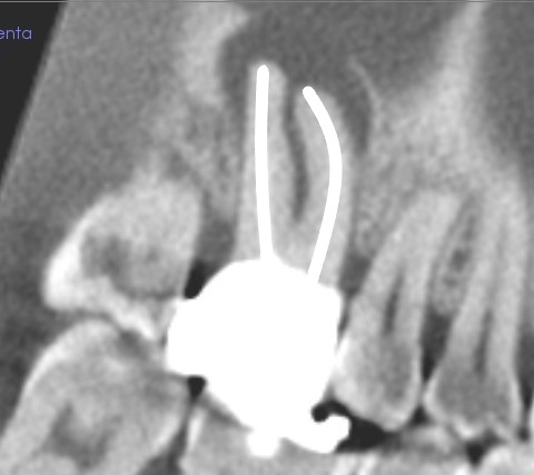 デンタルレントゲンでみる適正な根管充填