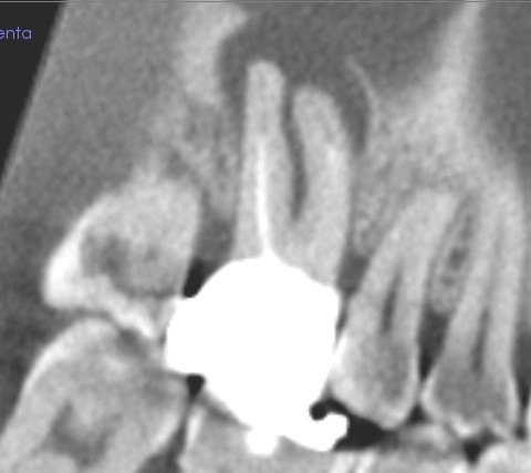短い根管充填のデンタルレントゲン写真