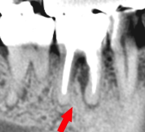 治癒傾向にある、穿孔による歯周組織の骨吸収