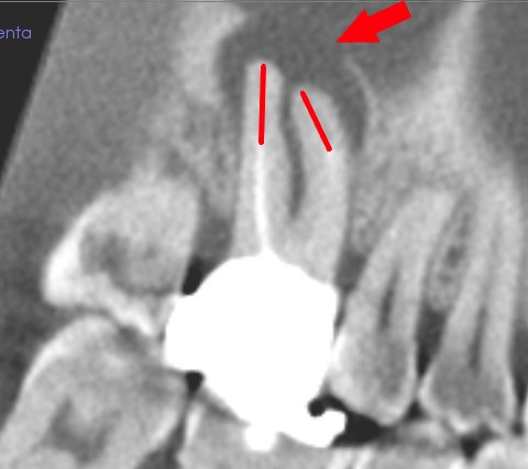 デンタルレントゲン上で見える根管充填の不足部分